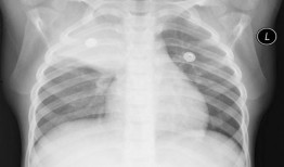 胸片爆料2025年最新版,揭示未来医疗影像技术新趋势